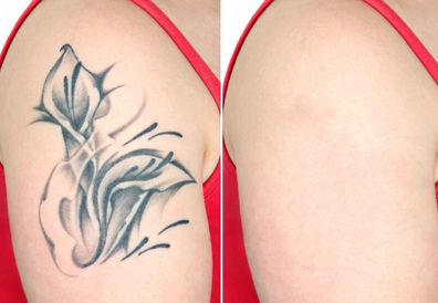  Tattoo Removal Treatment